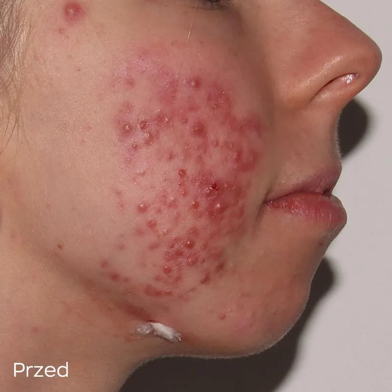 Porównanie trądziku i księdza